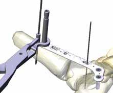 Step 7 Joint Space Reduction 7-1 After insertion of the calcaneal screws, compression is applied and maintained to reduce the arthrodesis (Figure 7-1).