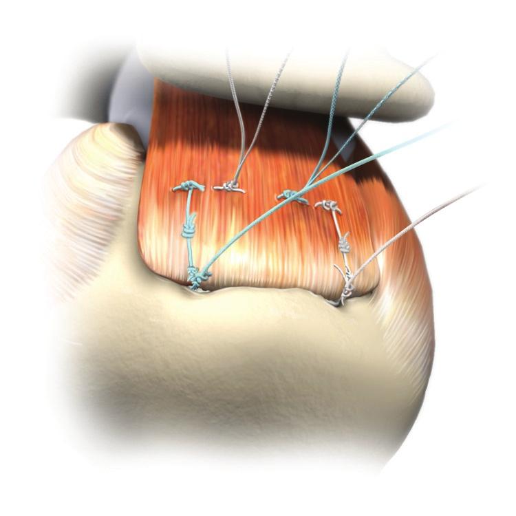 Alternating blue (co-braid) and white suture tails, utilize one blue suture from the anterior medial anchor and tie to blue suture tail from anterior lateral anchor, thus creating a knot midway from
