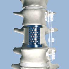 Final construct: the Stryker Spine anterior