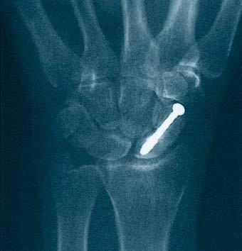 Indications For fracture fixation of small bones and small bone