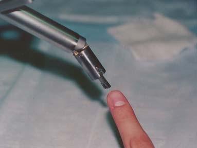 Figure 2: Slave manipulator of the UCB/UCSF laparoscopic telesurgical workstation. Closeup view of the millirobotic wrist is shown on the right. 2.2 Second Generation Prototype The slave manipulator is composed of two parts (Fig.