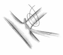 CHAPTER 2 19 Free tie Stick tie FIGURE 1 LIGATURES FIGURE 2 CONTINUOUS SUTURES Also referred to as running stitches, continuous sutures are a series of stitches taken with one strand of material.