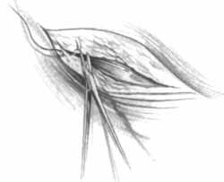 Apply force in the tissue to be sutured in the same direction as the curve of the needle. 2. Do not take excessively large bites of tissue with a small needle. 3.