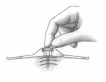 The final stitch is completed by passing the needle from the outside in, cutting one strand, and passing the needle through the opposite wound edge from the outside in.