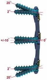Screw Angulation Cephalad/Caudal Angulation In-situ Fixed Screws are positioned at fixed trajectory at the following angles: