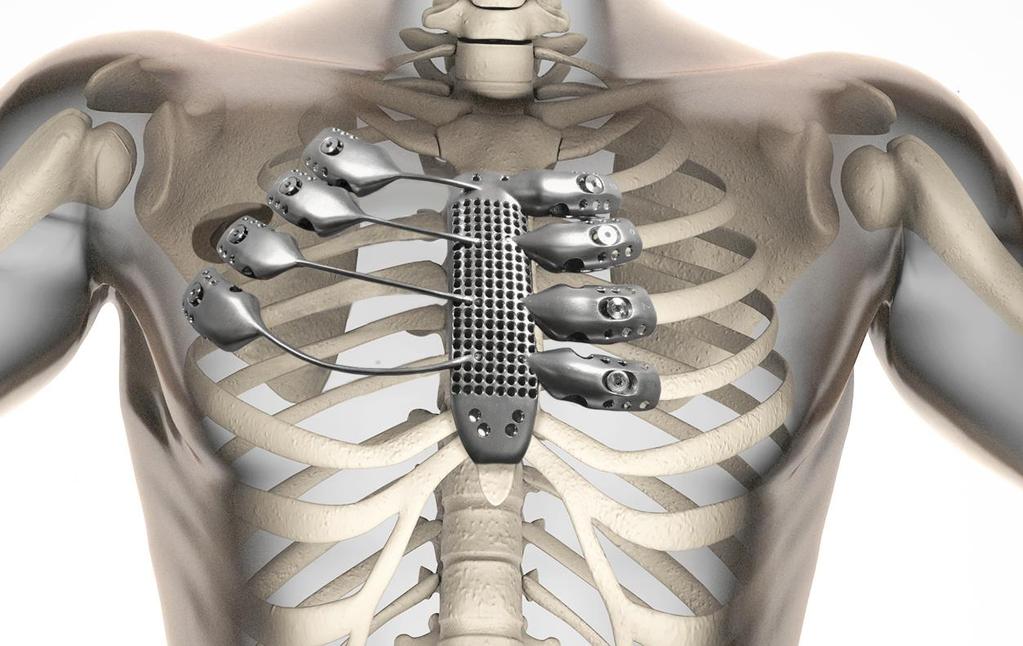 A 54-year Australian suffering from chest wall sarcoma received a 3D printed titanium sternum