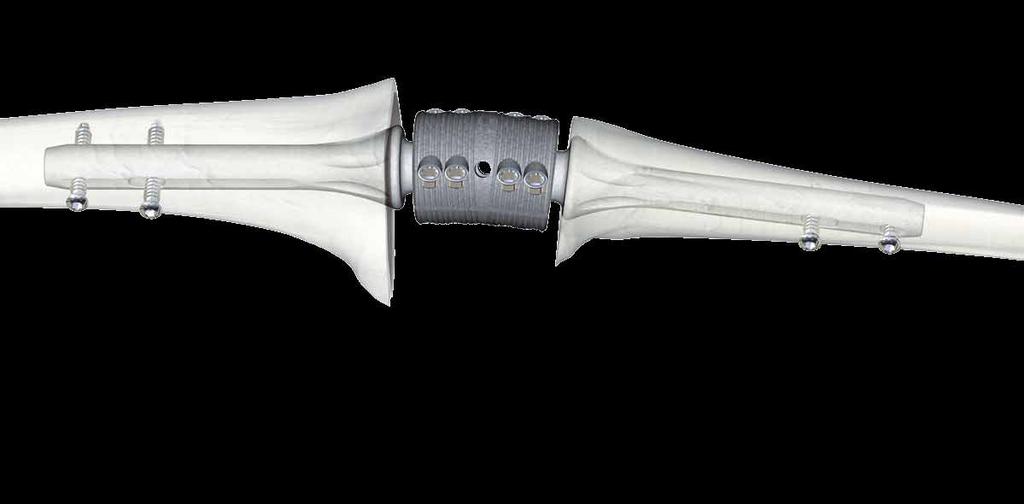 OsteoBridge Knee Arthrodesis System 01. OsteoBridge Knee Arthrodesis The OsteoBridge Knee Arthrodesis serves as an implant to fuse the knee after failed primary knee arthroplasty.