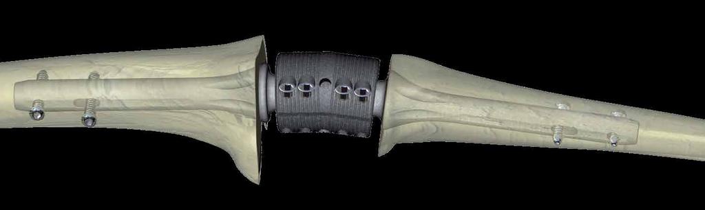 provide rotational stability By rotating the angled spacer, the surgeon may adjust both the extension/flexion and valgus/varus positioning of the joint Hollow spacer shells can be used as a carrier