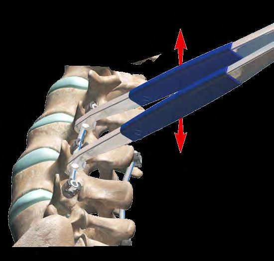 rod. (Fig. 16) Note: The top loading body and the set screw can cross thread if the axis of both implants are not aligned prior to insertion.