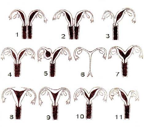 Scopul ale organelor genitale feminine interne. Obiectivele 1.Variante anatomice ale uterului, tromp specialitate.