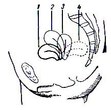 atunci cînd lungimea trompei din dreapta este mai mare decît cea din stînga numai mult de 5-47 mm. S- anomaliile uterului.