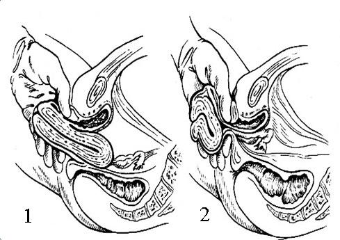 In Fig. 6 este demonstrat modul de indentificare a gradului de Concluzii 1) Fig.6. Indentificarea ptozei idualitatea polimorfismului în uterine. 1. procesul de dezvoltare a organelor genitale feminine interne.