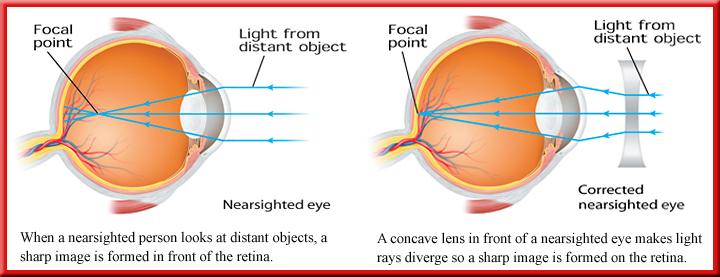 3 Mirrors, Lenses, and the Eye Nearsightedness Eyes cannot form a sharp image on