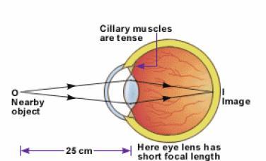 In this case the ciliary muscles contract, making the central portion of the convex lens bulge. The focal length of the convex lens now decreases.