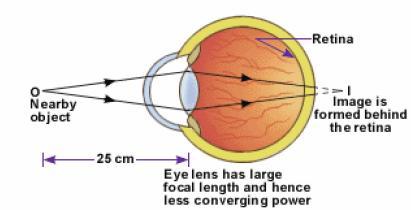 This ability to focus objects at various distances is called as the accommodation of the eye. But the accommodation has limitations. Closer than 25cm, our eyes will see objects in a defocused fashion.