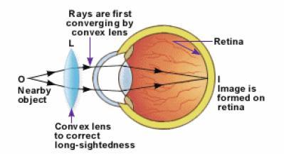 People suffering from long sightedness can see distant objects clearly but are unable to read from a book held close. Hence they need only reading glasses.