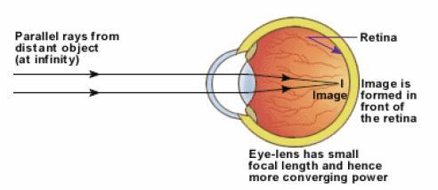 In this case the image of an object placed at far off distance is formed in front of the retina. To correct this defect, a concave lens has to be worn by the person.