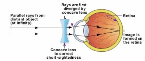 The adjustment of the focal length of the concave lens has to be in such a manner that a well focused image is formed at the retina.