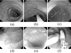 Estimating the view mode is a challenging problem due to the complexity and individual variation of the colon structure, colonic motility, changes in mucosal brightness related to light source to