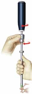 SURGICAL TECHNIQUE GUIDE The minipolyaxial screwdriver was designed to both insert and back out the polyaxial screws.