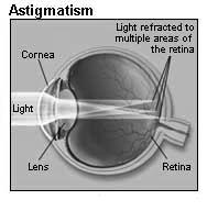Common Vision Problems Astigmatism is