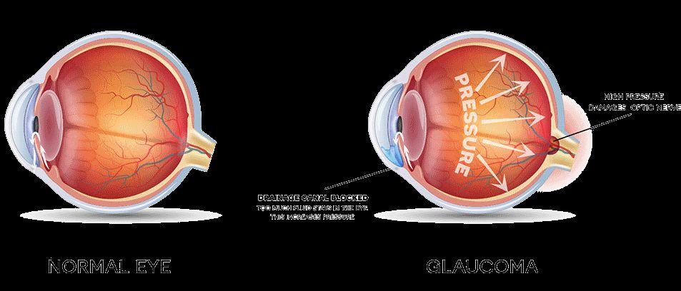 Glaucoma Happens when aqueous humor builds in the front part of your eye because it doesn't