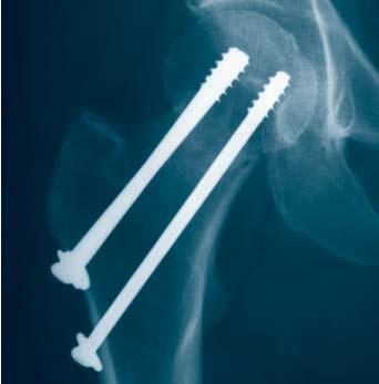 Indications For fracture fixation of large bones and large bone