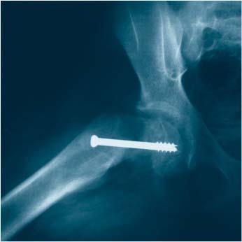 femoral epiphyses As an adjunct to DHS in basilar neck fractures