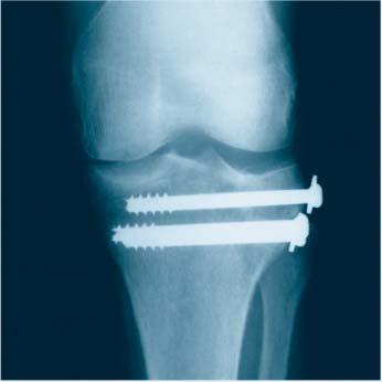 3 mm titanium screws may be used with the Titanium Femoral Nail