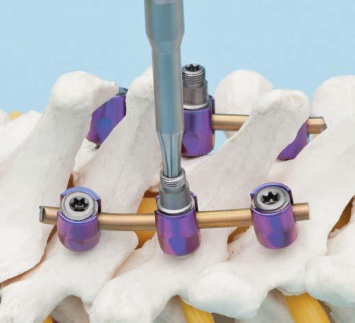 Insert top loading transconnectors Note: The Synapse Top Loading Transconnector, compatible only with the Synapse System, is placed on top of two monosegmental variable axis screws (T1 T3) to cover