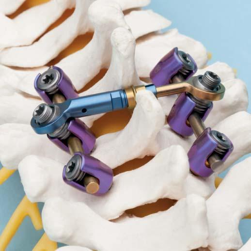 Place the transconnector on the Synapse screw construct to assess fit. Hold the transconnector with the holding forceps. Adjust as necessary.