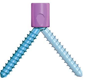 Implants Variable axis screws For use with 3.5 mm rods (purple screwhead) For use with 3.5 mm and 4.0 mm rods (teal screwhead) Cancellous screws 3.5 mm and 4.0 mm cancellous screws offer up to 50 of angulation in all directions 4.