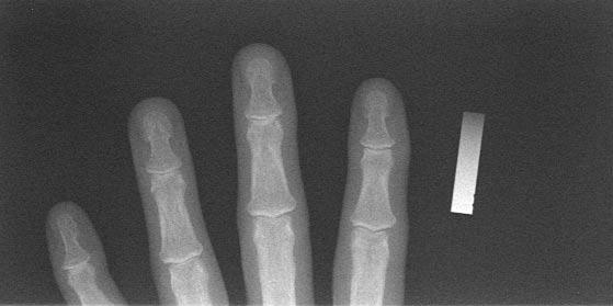 Images of the patient s hand are scanned using the ACLxy as the input source for Osteogram reports.