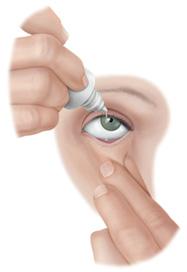 (A) pulling the lower lid down with your index finger or If you experience any side effects, contact your ophthalmologist immediately. Tell your other doctors if you are using eyedrops for glaucoma.