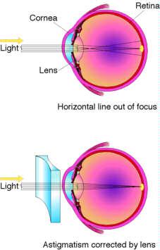 Astigmatism Eye defects cornea retina light lens Rays in