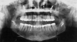 The prototype receptor (the recording medium) most commonly used in dental radiography is the radiographic film.