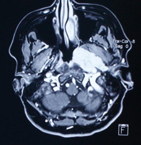 Surgical Strategy in the Transcervical Approach of the Parapharyngeal Tumors in Aeronautical Military Personnel CLINICAL DIAGNOSIS Small size parapharyngeal space tumors may not be symptomatic, or