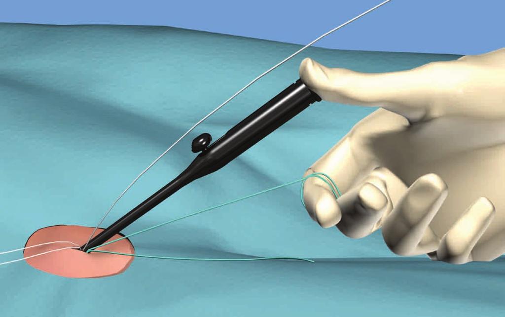SINGLE HAND KNOT ADVANCEMENT White suture is closest to artery Interarterial view