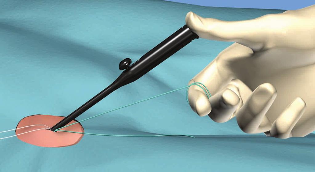 HEMOSTASIS Apply constant, gentle pressure to the Knot Pusher and pull on the suture wrapped around index finger until hemostasis is achieved.
