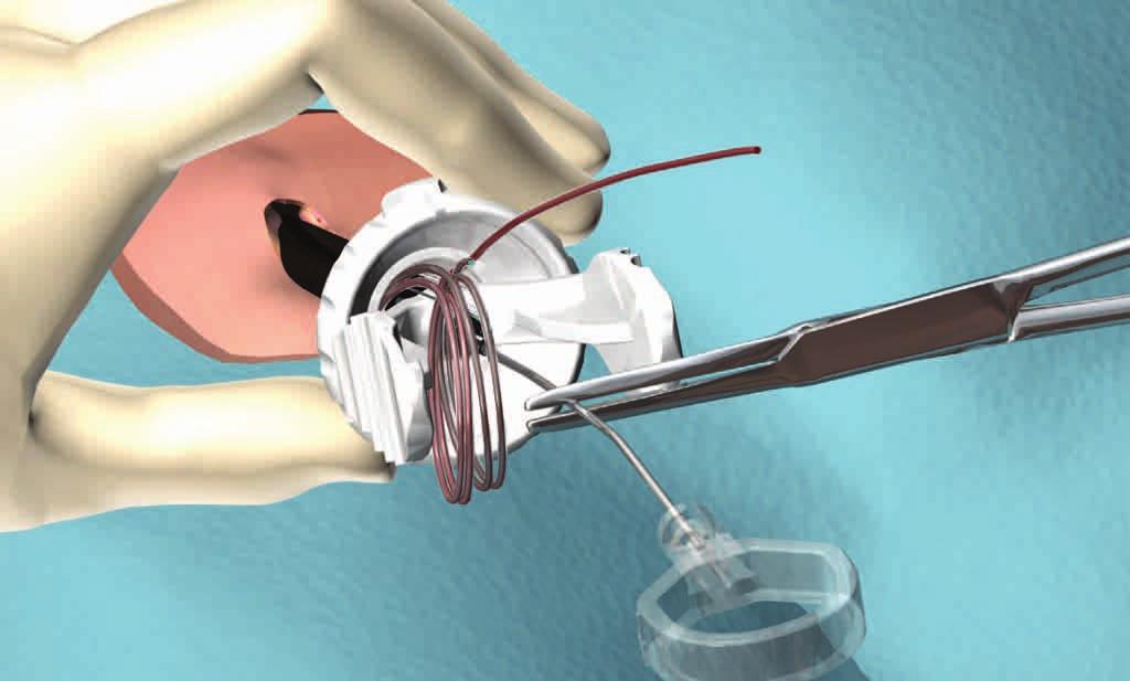 NEEDLE BACKDOWN Needles LATERAL VIEWS Radiopaque Sheath Ring If needles are not easily deployed, back the needles down into the sheath prior to device removal.
