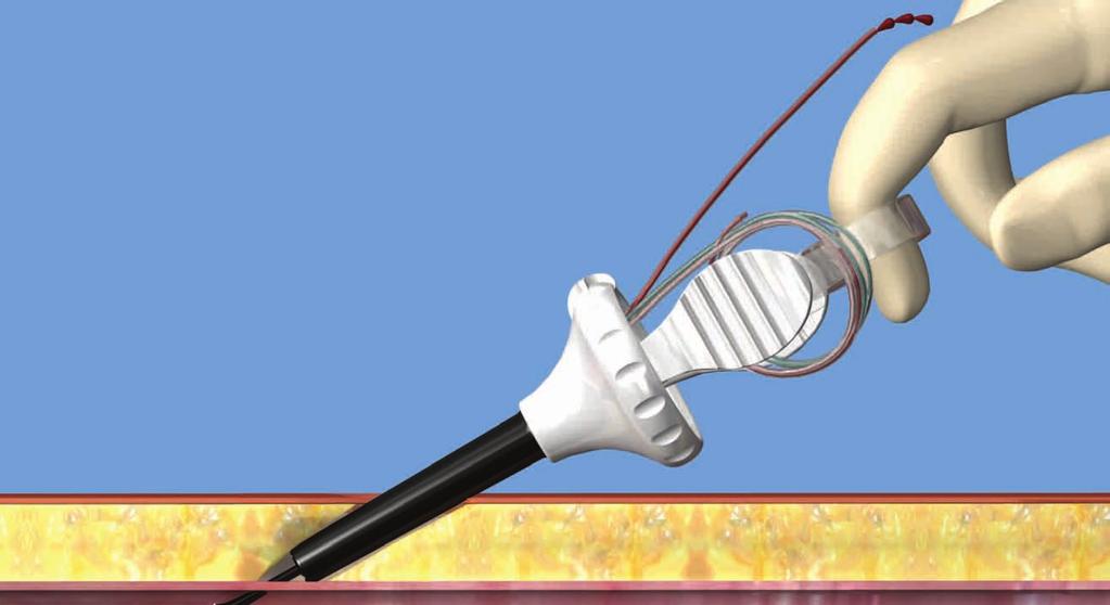 NEEDLE DEPLOYMENT Pulsatile Marking Marker Lumen Needle Tips STAR Hub Handle Suture Lumens 45º 4 Visually