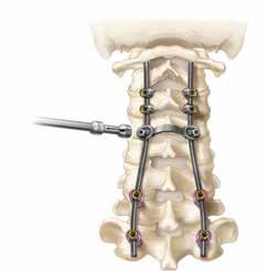 The Gibralt System offers two different types of transitional rods, which can be linked to thoracic components.