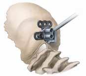 Figure 1 Occipital Plate Attach the Plate Holder/Drill Guide to the occipital plate and place the plate against the occiput. The Occipital plate should lie smoothly against the bone.