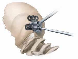 TAP Due to the thickness of the occipital bone, it is recommended that the bone is fully tapped prior to the insertion of the screw.