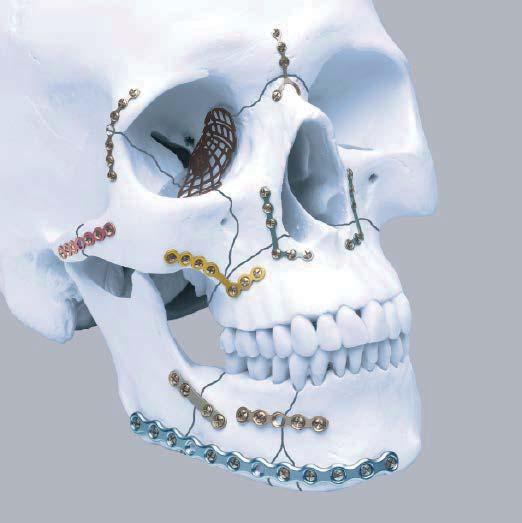 INDICATIONS The Synthes MatrixMIDFACE Plating System is intended for use in selective trauma of the midface and craniofacial skeleton; craniofacial surgery; reconstructive procedures, and selective
