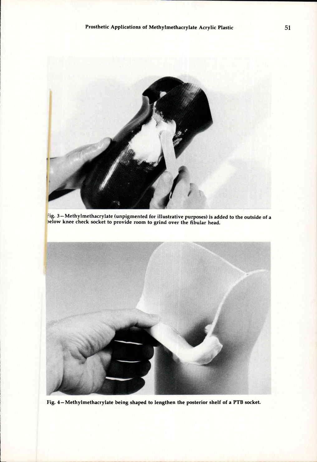 Fig. 3 - Methylmethacrylate (unpigmented for illustrative purposes) is added to the outside of a below knee check socket to