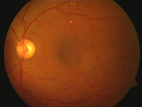 by pixels belonging to the background. In a fundus mask, pixels belonging to the fundus are marked with ones and the background of the fundus with zeros.