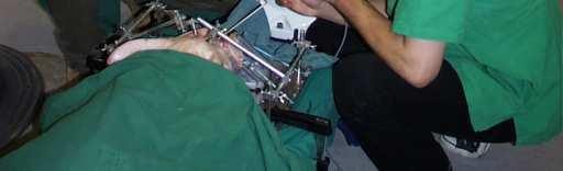 The surgeon manually guided the robot arm along the trajectory whereby his movements perpendicular to the cutting line