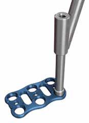 Variable Single Barrel Drill Guide The Variable Single Barrel Drill Guide, which has a blue handle, features a spherical shape at the tip of the guide shaft, which allows the guide to angulate on the