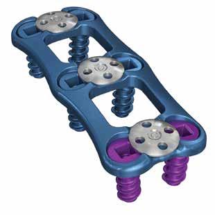 The Locking Screw locks the bone screws in place and allows for additional visual and tactile feedback that the bone screws are locked.